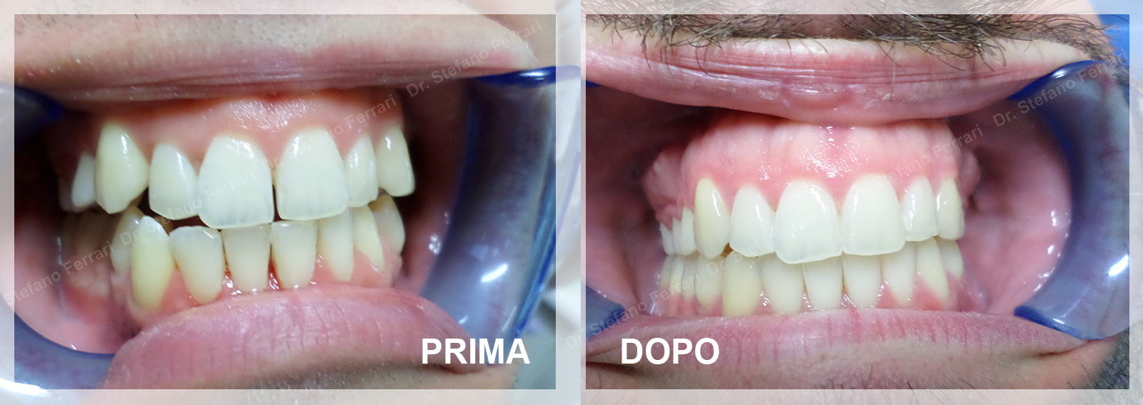 Apparecchio Denti Rovigo